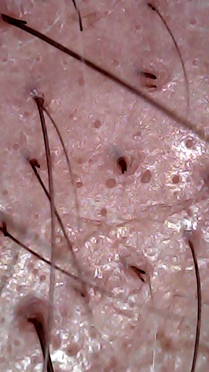 Couro cabeludo observado em detalhe através da câmara microscópica