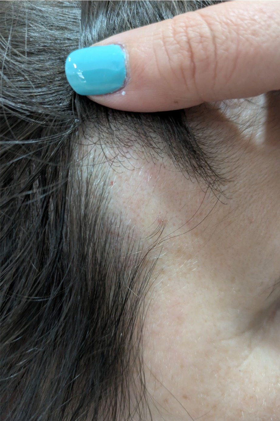 Antes — Caso 3 — Acompanhamento da linha frontal